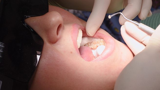 a dentist placing a tooth-colored filling