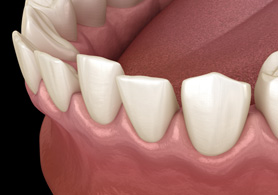 a digital illustration showing crowded teeth