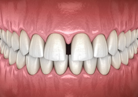 a digital illustration showing gapped front teeth