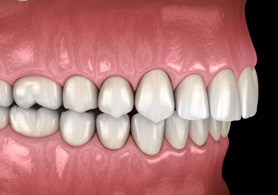 a digital illustration showing an overbite