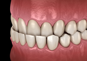 a digital illustration showing an underbite