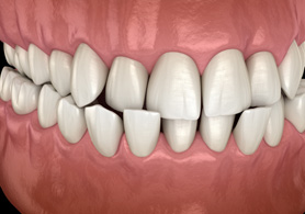 a digital illustration showing a front crossbite