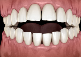 a digital illustration showing an open bite
