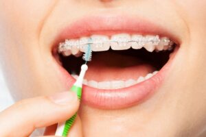 a person using an interdental toothbrush to clean between their braces brackets