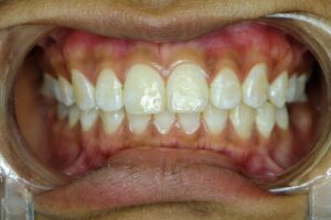 a person with white spots on their teeth